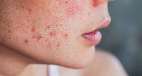 Ergenlikte Beden İmajı Nasıl Bozulabilir? Medya Etkisi, Uyarı İşaretleri ve Sağlıklı Yaklaşım