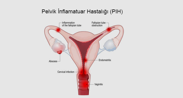 Pelvik İnflamatuar Hastalığı (PIH) Nedir? Belirtiler, Teşhis, Tedavi ve Uzun Vadeli Etkiler